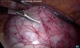 Kyste ovarien après hystérectomie