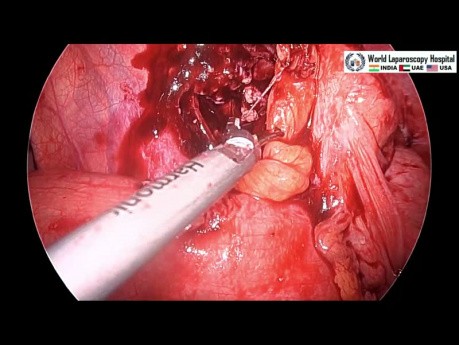 Prise en charge laparoscopique de l'appendicite perforée