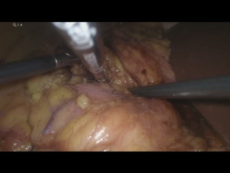 Surrénalectomie droite laparoscopique et tumorectomie rénale droite simultanées