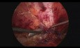 Chirurgie laparoscopique des hernies multiples - la technique de Rives-Stoppa