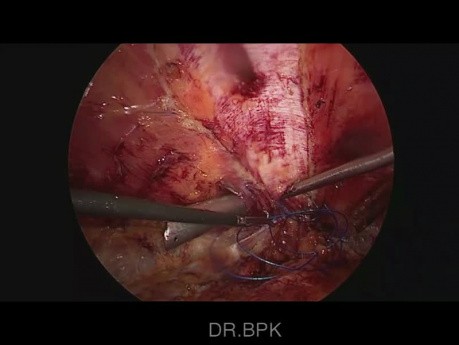 Chirurgie laparoscopique des hernies multiples - la technique de Rives-Stoppa