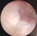  Ventriculostomie endoscopique du troisième ventricule dans un cas bénin du syndrome d'Aicardi avec hydrocéphalie obstructive et malformation de Chiari de type 1.