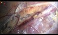 Comment Faire la Dissection danc une Varicocélectomie Laparoscopique préservant les Artères