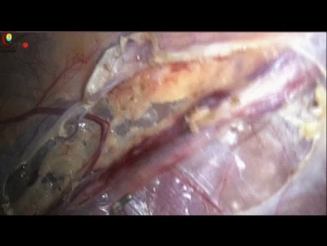 Comment Faire la Dissection danc une Varicocélectomie Laparoscopique préservant les Artères