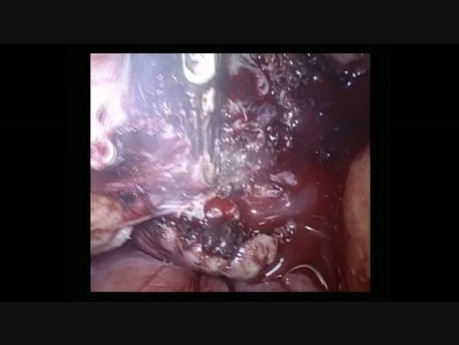 Myomectomie Laparoscopique