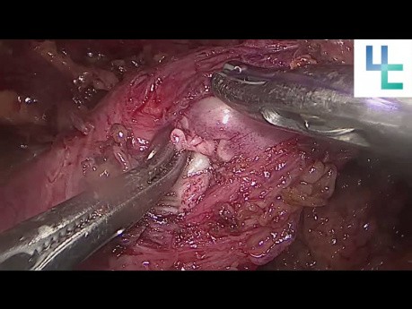 Réimplantation urétérale dans une greffe de rein