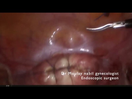 Polymyomectomie Laparoscopique Rapide et Sûre