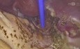 Ablacja termiczna helem w endometriozie nad jelitem Miso