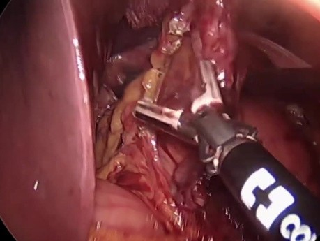 Hernie hiatal type IV