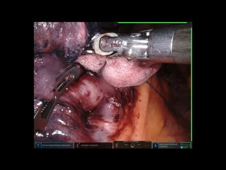 Lobectomie supérieure droite - chirurgie robot-assistée
