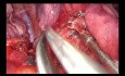 Segmentectomie postérieure droite S2 du poumon par chirurgie thoracique vidéo-assistée (CTVA) à l'incision unique