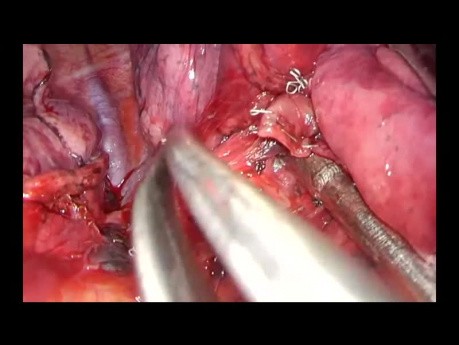 Segmentectomie postérieure droite S2 du poumon par chirurgie thoracique vidéo-assistée (CTVA) à l'incision unique
