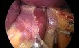 Anneau gastrique ajustable - laparoscopie