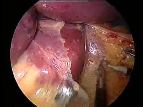 Anneau gastrique ajustable - laparoscopie