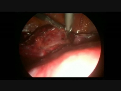 Gros fibrome utérin - hystérectomie laparoscopique