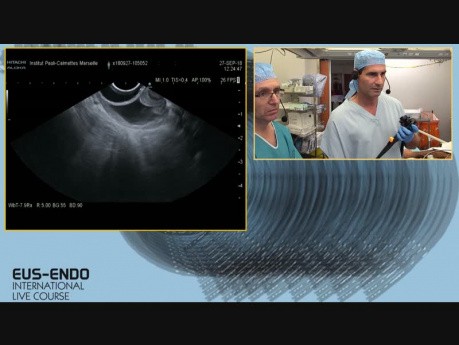 L'échographie endoscopique + injection d'un produit de contraste SONOVUE + l'échographie endoscopique et l'aspiration à l'aiguille fine