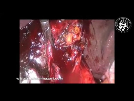 Utilisation d'un Dispositif d'Agrafage pour la Fermeture du Canal Cystique pour une Cholécystectomie Sûre dans la Cholécystite Fibreuse Aiguë