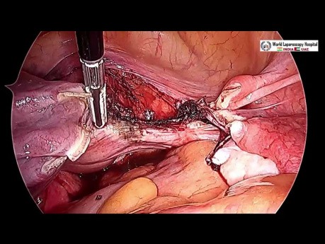 Hystérectomie laparoscopique totale avec annexectomie bilatérale
