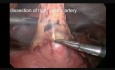 Oesophagectomie laparoscopique-thoracoscopique