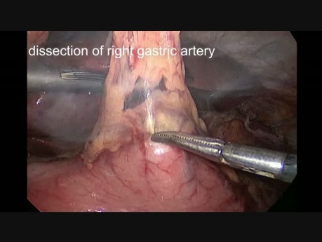 Oesophagectomie laparoscopique-thoracoscopique