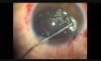 Contusion oculaire, vitrectomie antérieure, phacoémulsification, CTR et IOL