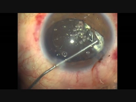 Contusion oculaire, vitrectomie antérieure, phacoémulsification, CTR et IOL