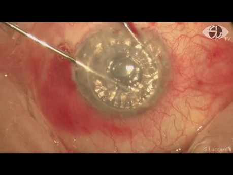 Kératoplastie endothéliale avec stripping automatisé de la membrane de Descemet dans implantation de la valve Ahmed