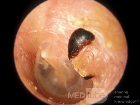 Perforation traumatique de la membrane tympanique gauche guérie après un mois