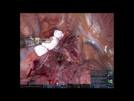 Segmentectomie S1 Droite Robotisée (Non-éditée)