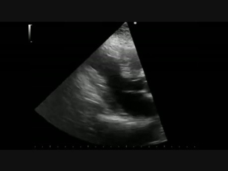 Syndrome coronarien - cas clinique. L'écho d'effort et l'angiographie coronaire sont montrés et discutés