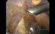Cholécystectomie laparoscopique chez un patient avec antécédent d'intervention chirurgicale hépatique par laparotomie