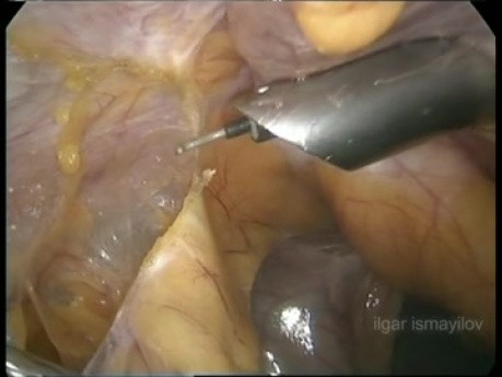 Cholécystectomie laparoscopique chez un patient avec antécédent d'intervention chirurgicale hépatique par laparotomie