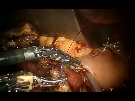 Notre méthode de création de pancréatogastroanastomose lors d'une procédure de Whipple par voie laparoscopique assistée par robot 