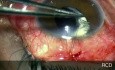 La technique de l'utilisation d'implants de drainage pour glaucome.