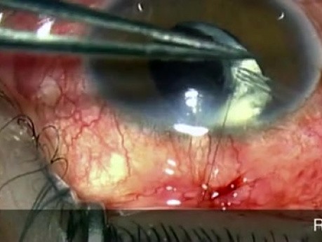 La technique de l'utilisation d'implants de drainage pour glaucome.