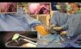Formation des Résidents sur la Cholécystectomie Laparo-Endoscopique à Site Unique (LESS) sous Anesthésie Péridurale