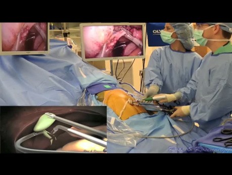 Formation des Résidents sur la Cholécystectomie Laparo-Endoscopique à Site Unique (LESS) sous Anesthésie Péridurale
