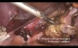 L'hystérectomie en cas du fibrome cervical.