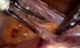 Hystérectomie laparoscopique totale - Technique standard