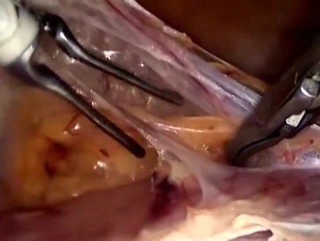 Hystérectomie laparoscopique totale - Technique standard