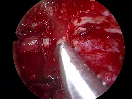 Angiofibrome Juvénile - Chirurgie des Sinus