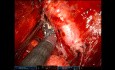 Reprise de Pneumonectomie par RATS Uniportale Après Deux Thoracotomies Antérieures (Lobectomie et Lingulectomie)