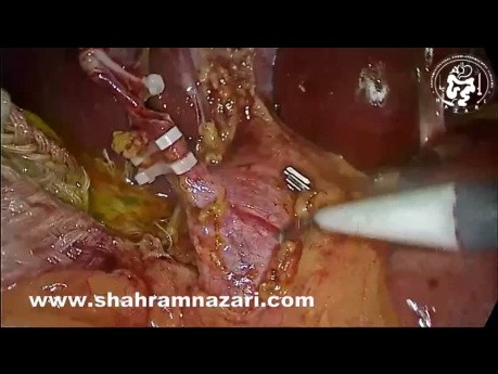 Exploration Laparoscopique du Cholédoque, Sphinctérotomie Antérograde, Stent du Cholédoque