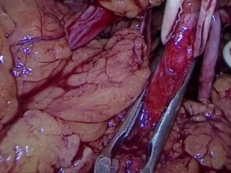 Néphrectomie partielle par voie laparoscopique