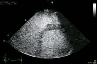Un image correcte du ventricule droit