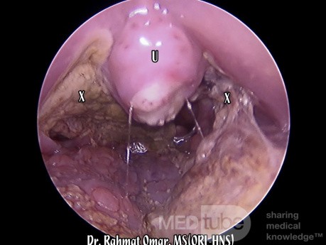 Complication Infectieuse Post-Amygdalectomie