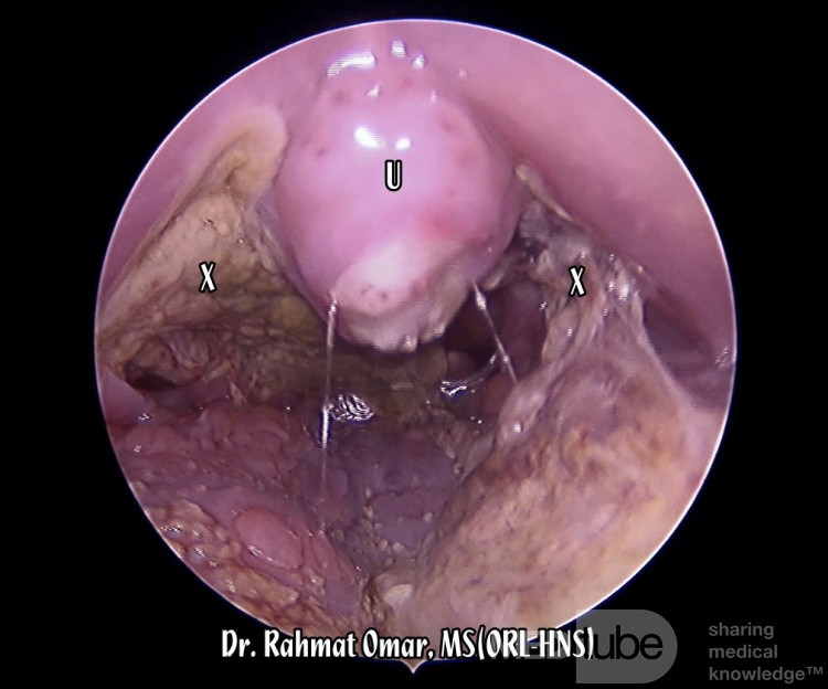 Complication Infectieuse Post-Amygdalectomie