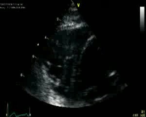 Un image correcte du ventricule droit