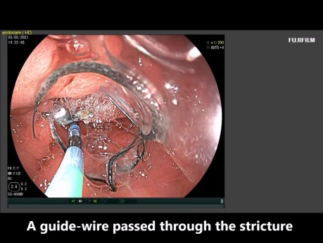 Gastroentérostomie guidée EUS chez un patient souffrant d'ascite