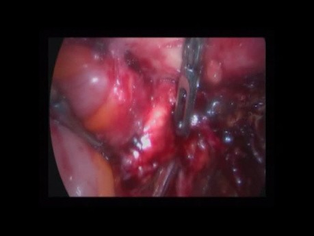 Hystérectomie laparoscopique, l'endométriose